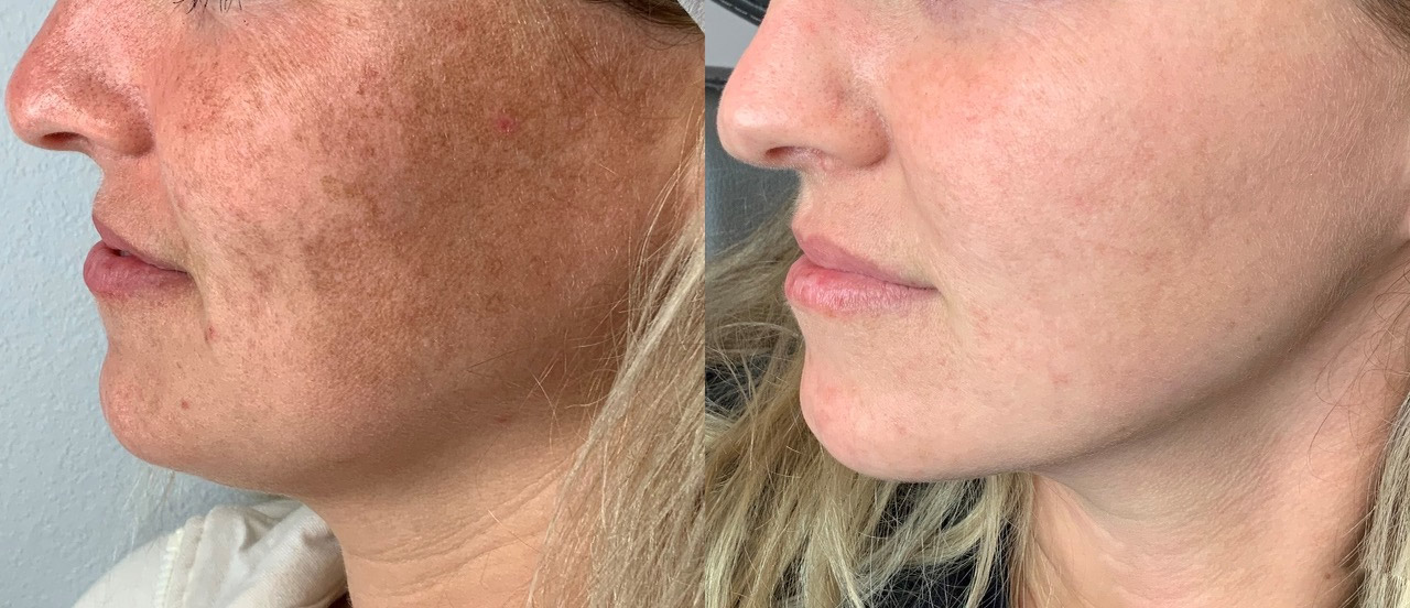 Lumecca Skin Treatment in Phoenix AZ